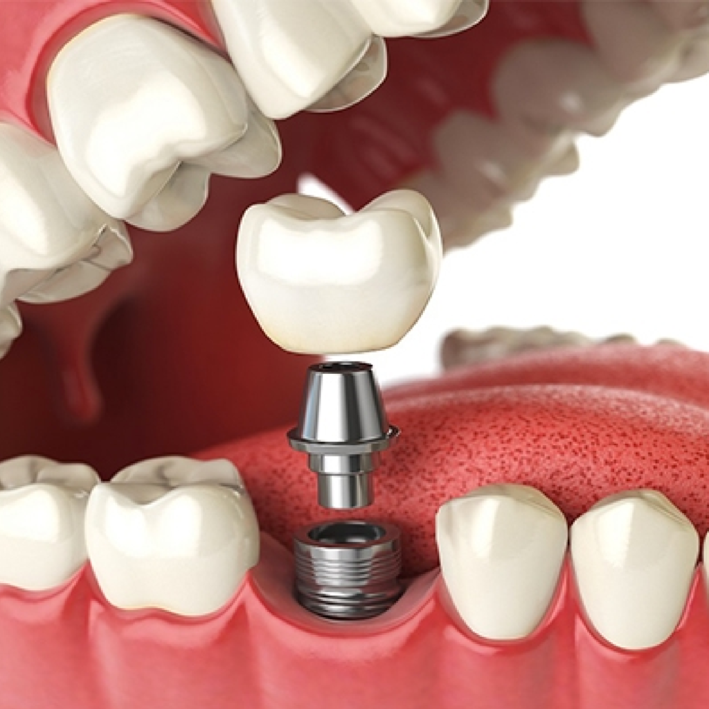 implantes e próteses